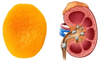 Dried Apricot and kidney stones